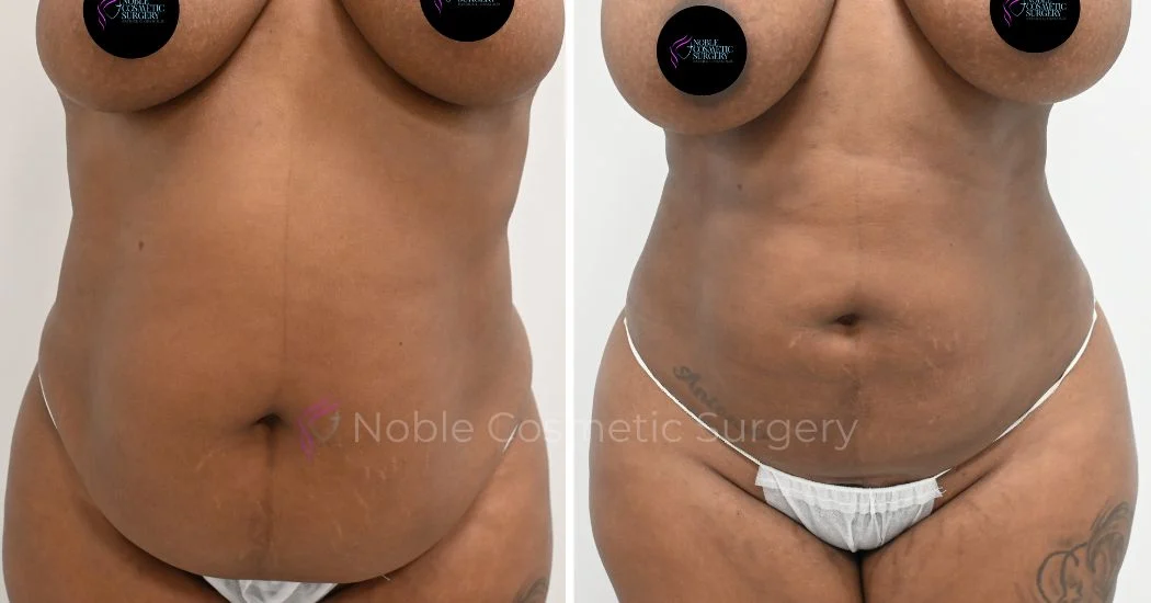 P21-00921L | Before and After Liposuction 1