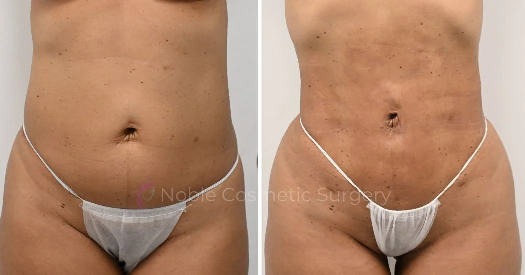 P22-00922L | Before and After Liposuction 1