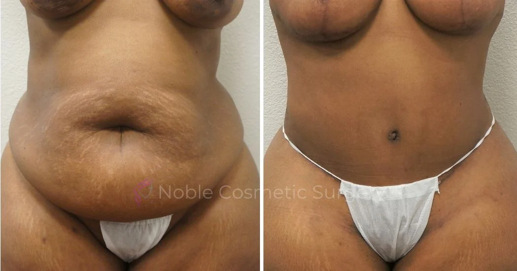 P23-00302A | Before and After Abdominoplasty 1