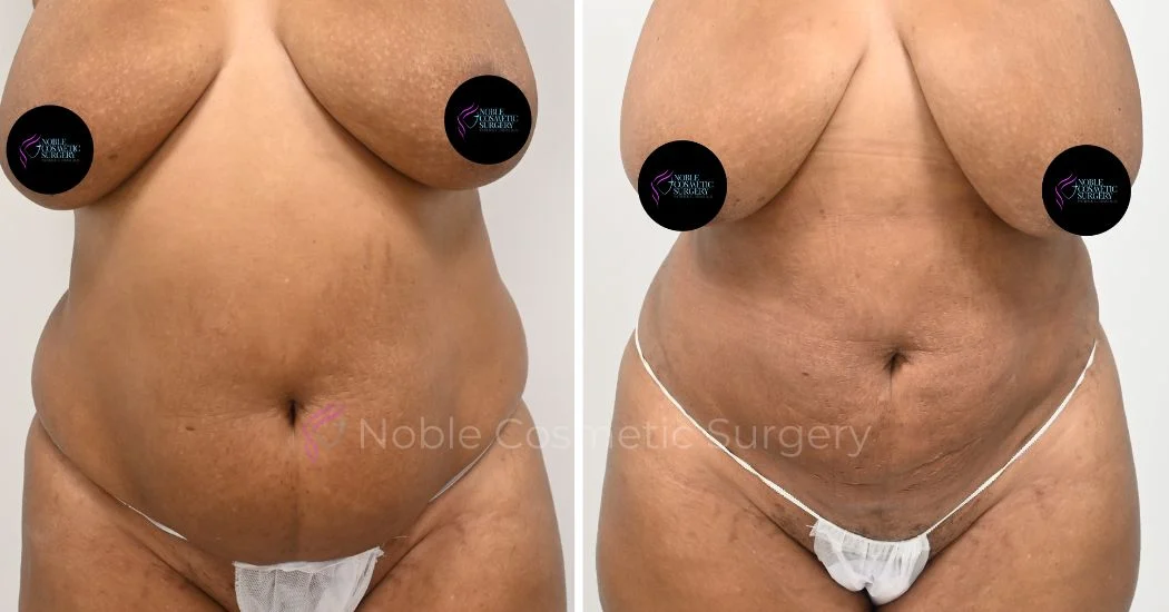P23-00923L | Before and After Liposuction 1