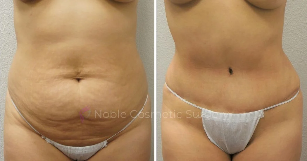 P24-00304A | Before and After Abdominoplasty 1