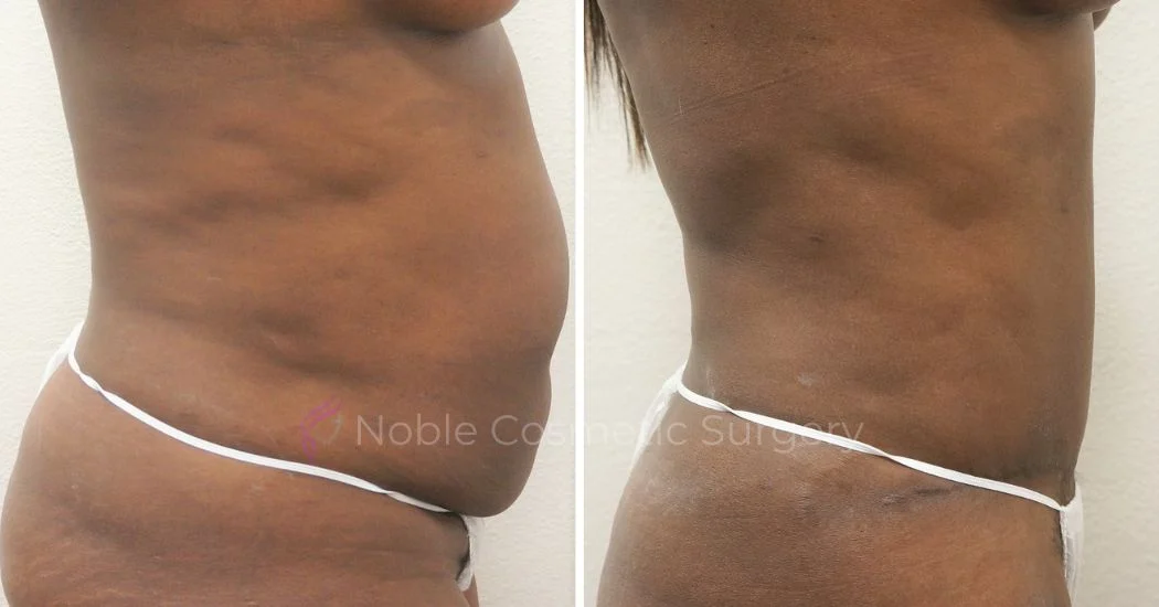P25-00305A | Before and After Abdominoplasty 3