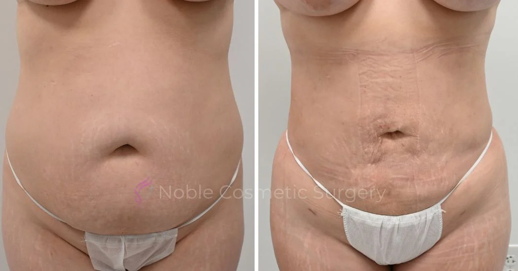 P25-00925L | Before and After Liposuction 1