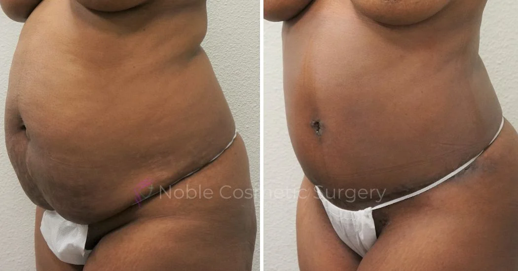 P26-00306A | Before and After Abdominoplasty 2