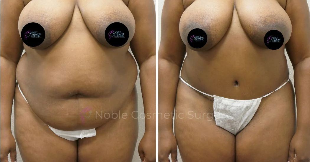 P27-00307A | Before and After Abdominoplasty 1