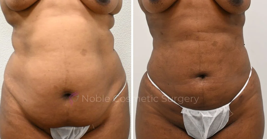 P27-00927L | Before and After Liposuction 1