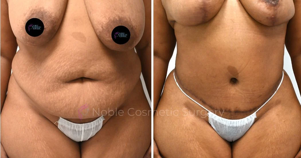 P29-00309A | Before and After Abdominoplasty 1