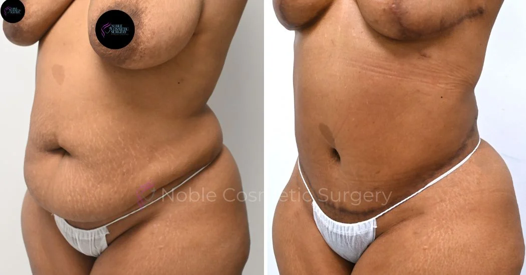 P29-00309A | Before and After Abdominoplasty 2