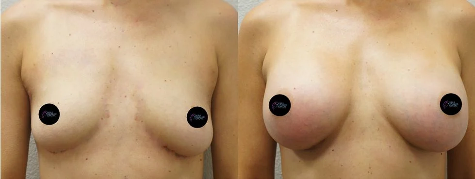 P3- 00054 | Before and After Breast Augmentation 1