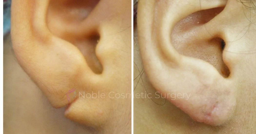 P3-00802E | Before and After Earlobe Repair 1