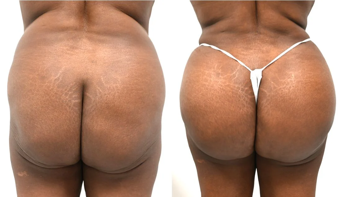 P3-00902-BBL | Before and After Brazilian Butt Lift 1