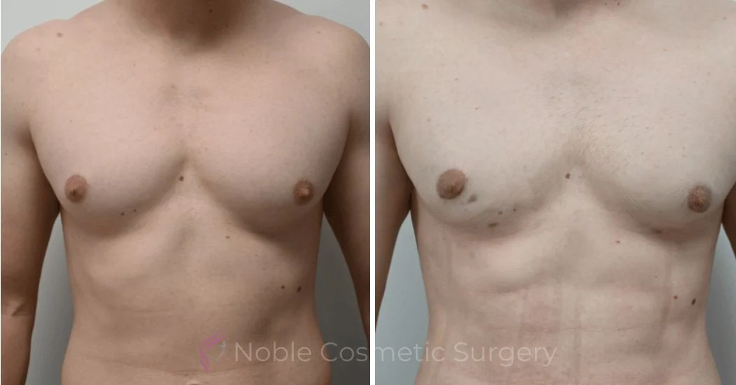 P3-17230 | Before and After Gynecomastia 1