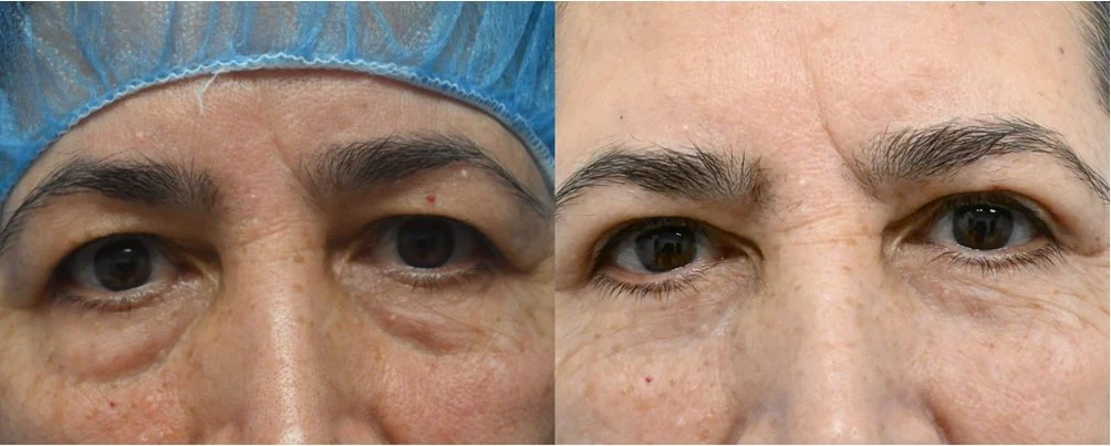 P3-19865 | Before and After Blepharoplasty 1