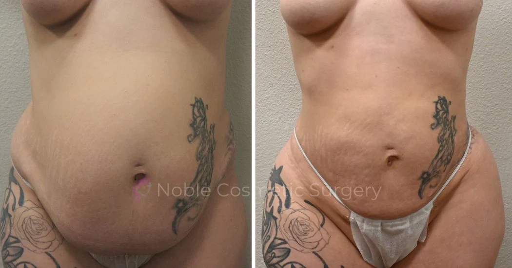 P31-00931L | Before and After Liposuction 1