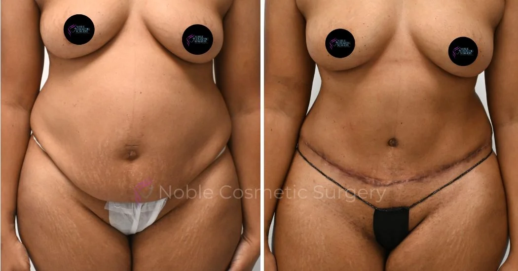 P32-00312A | Before and After Abdominoplasty 1