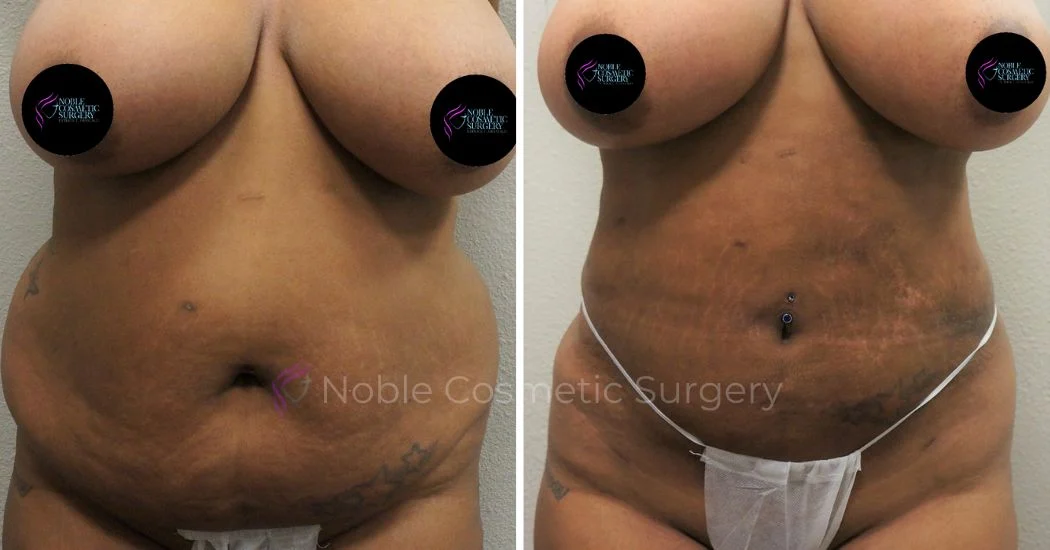 P32-00932L | Before and After Liposuction 1