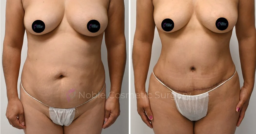 P33-00313A | Before and After Abdominoplasty 1