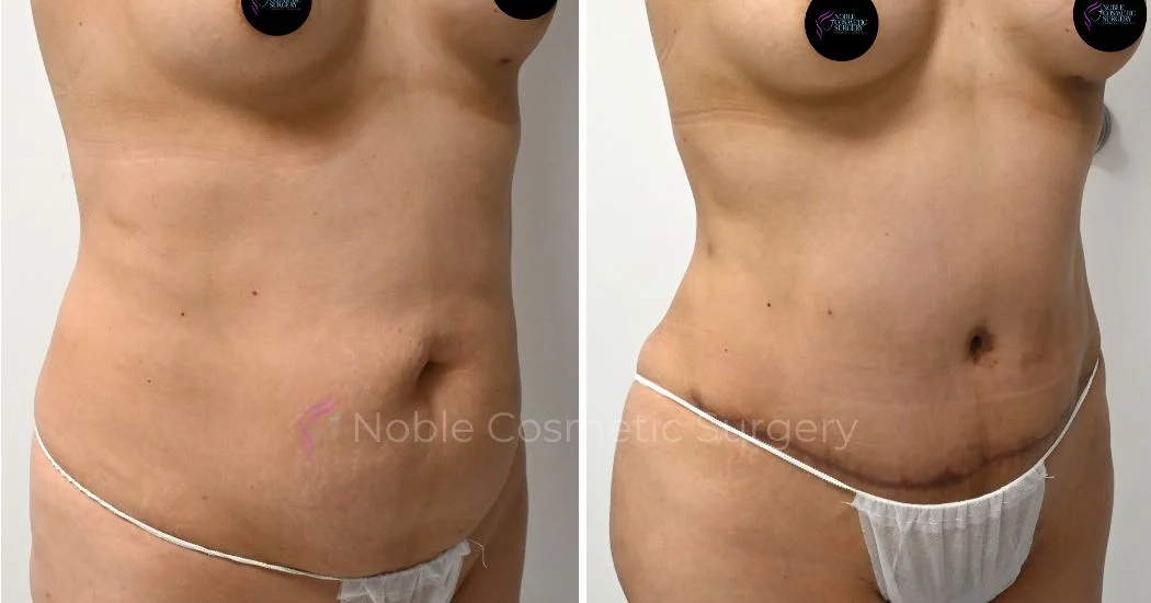 P33-00313A | Before and After Abdominoplasty 2