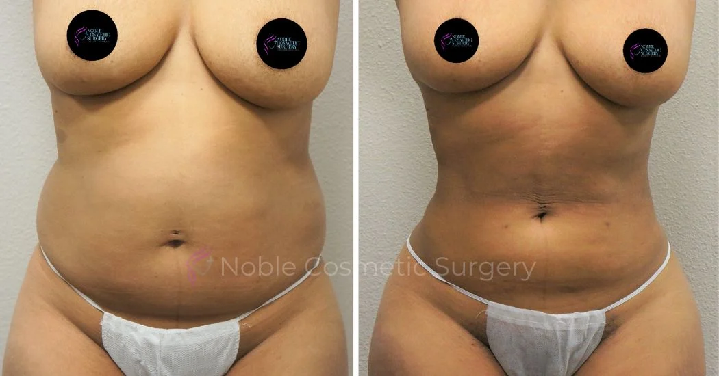 P33-00933L | Before and After Liposuction 1