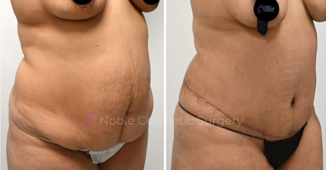 P34-00314A | Before and After Abdominoplasty 2