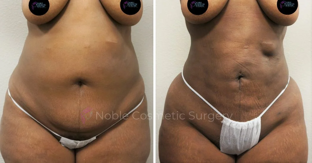 P36-00936L | Before and After Liposuction 1
