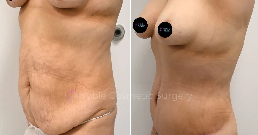 P37-00317A | Before and After Abdominoplasty 2