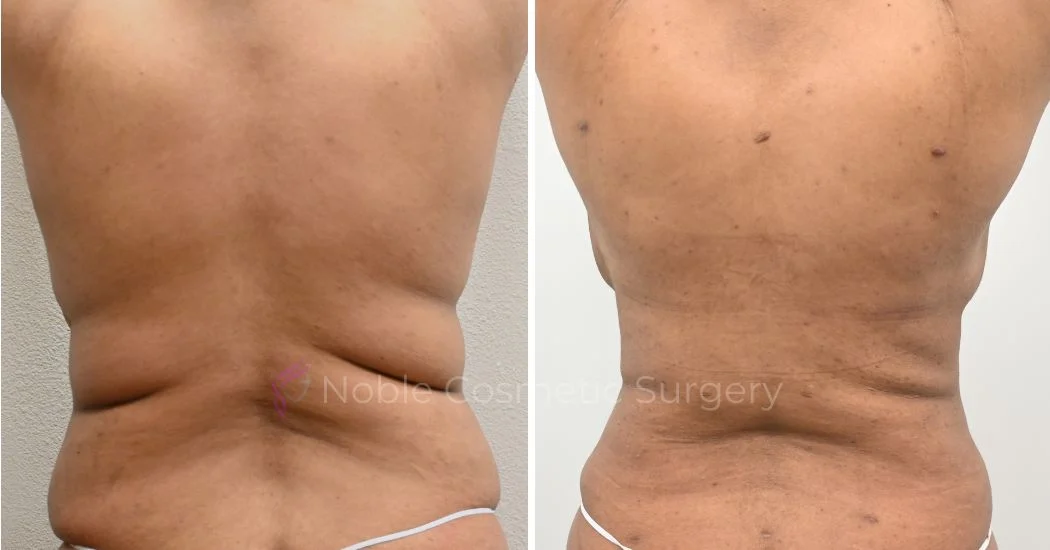 00035 | Before and After Abdominoplasty 3