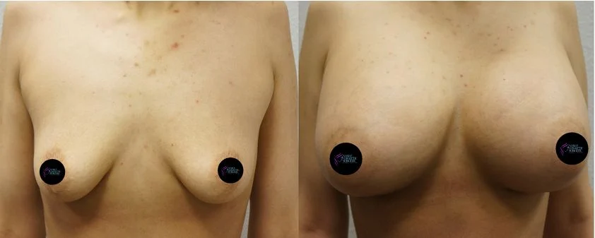 P4-00056 | Before and After Breast Augmentation 1