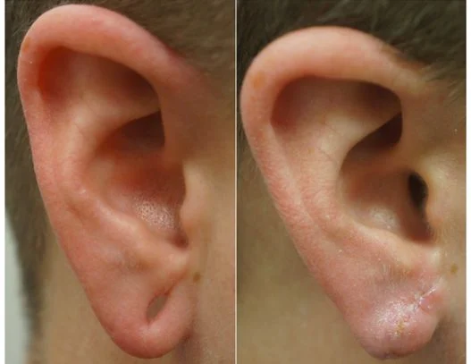 P4-00803E | Before and After Earlobe Repair 1