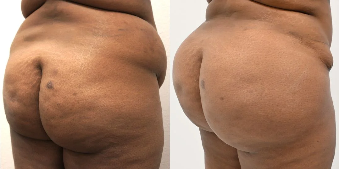 P4-00903-BBL | Before and After Brazilian Butt Lift 1
