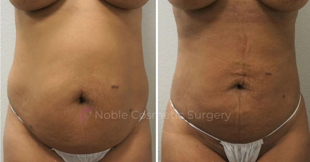 P4-00904L | Before and After Liposuction 1