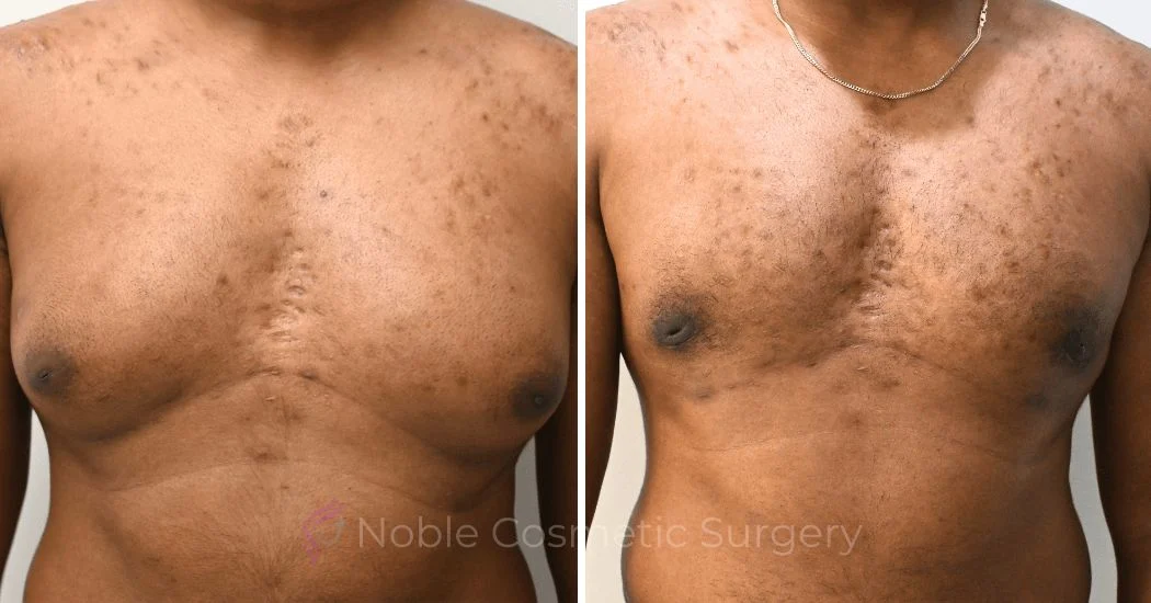 P4-10891 | Before and After Gynecomastia 1