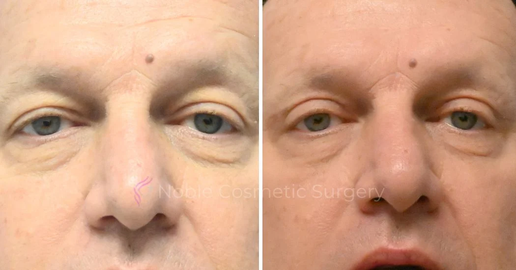 Before and after photo 4