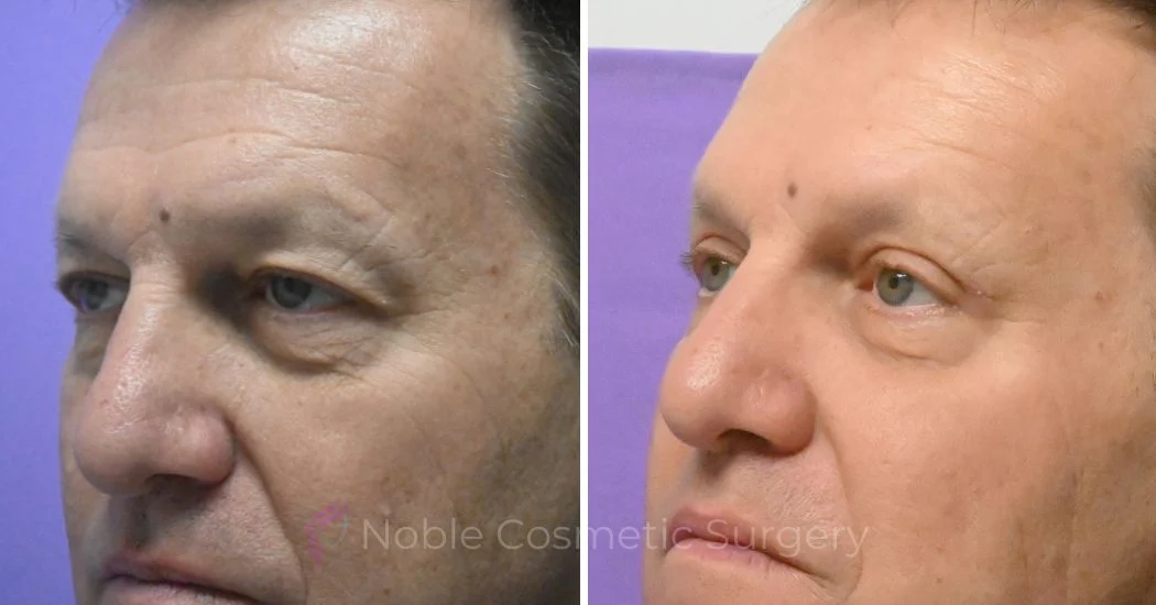 P4-19638 | Before and After Blepharoplasty 3