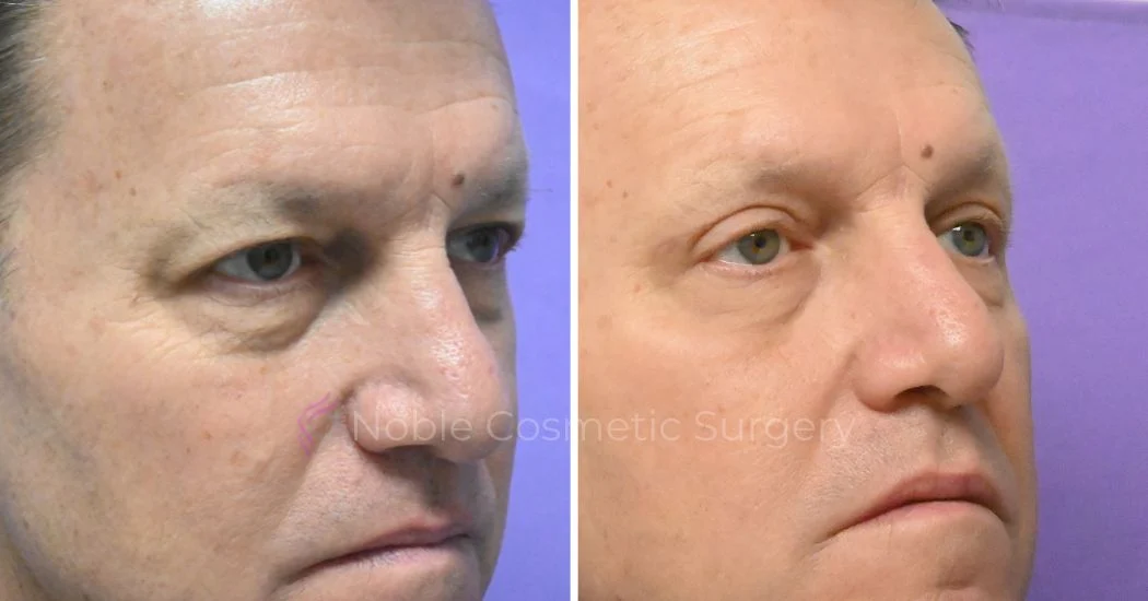 P4-19638 | Before and After Blepharoplasty 2