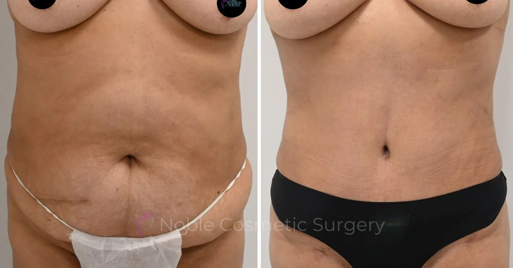 P42-00324A | Before and After Abdominoplasty 1
