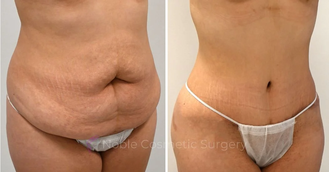 P43-00325A | Before and After Abdominoplasty 2