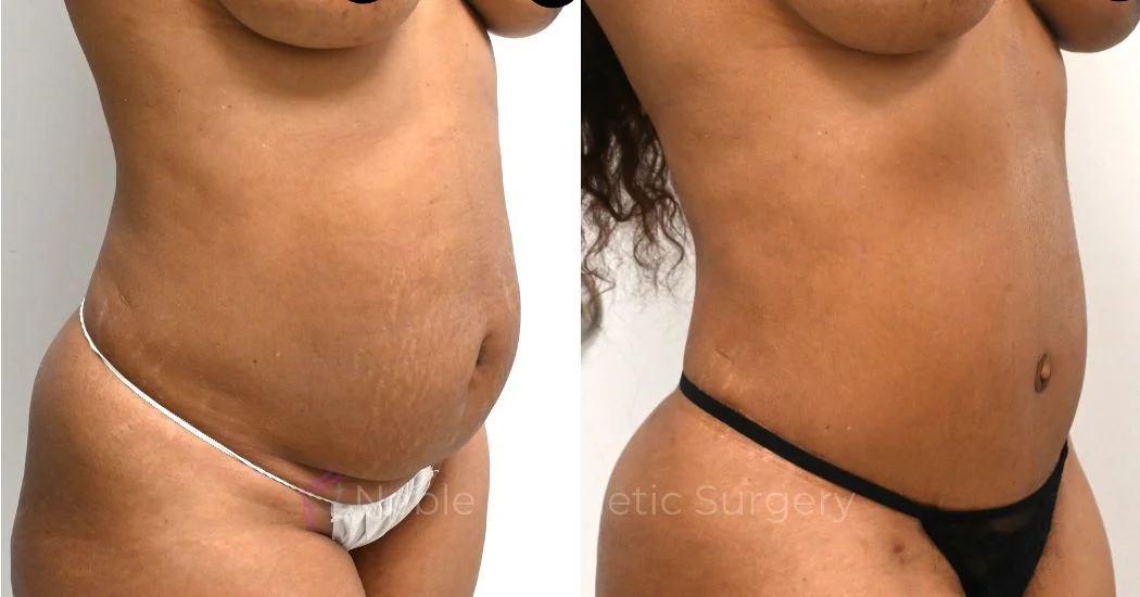 P44-00326A | Before and After Abdominoplasty 2