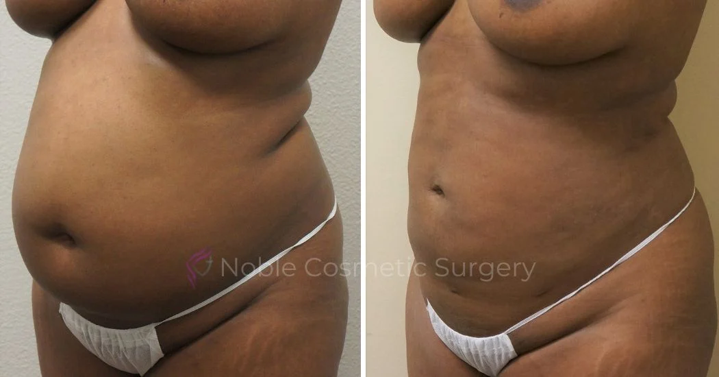 P44-00944L | Before and After Liposuction 2