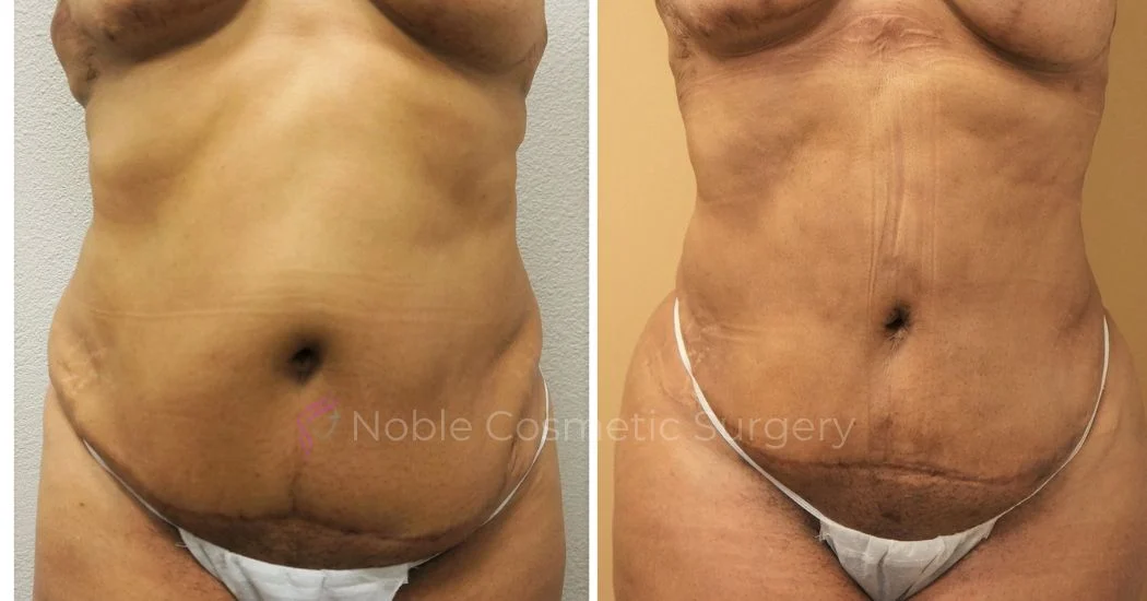 P45-00945L | Before and After Liposuction 1