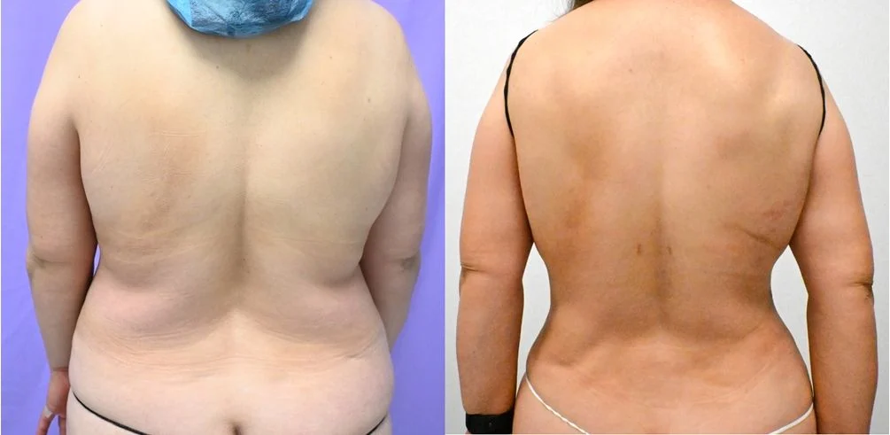 P46-19828A | Before and After Abdominoplasty 4
