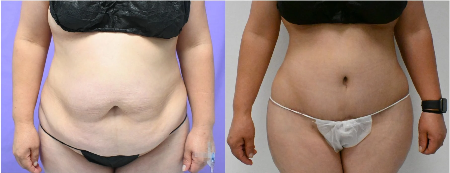 P46-19828A | Before and After Abdominoplasty 1