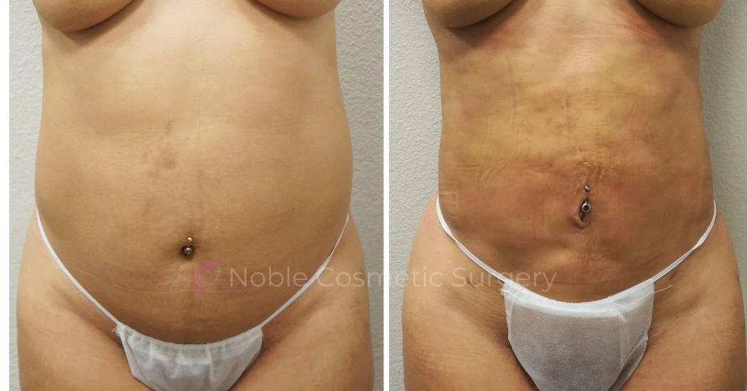 P47-00947L | Before and After Liposuction 1