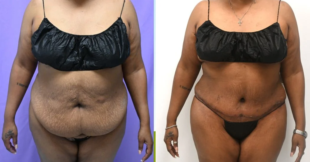 P49-12161A | Before and After Abdominoplasty 1