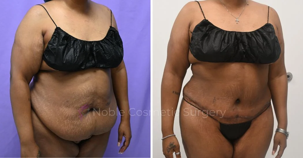 P49-12161A | Before and After Abdominoplasty 3