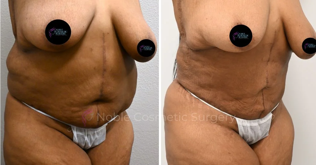 P5-00036A | Before and After Abdominoplasty 2