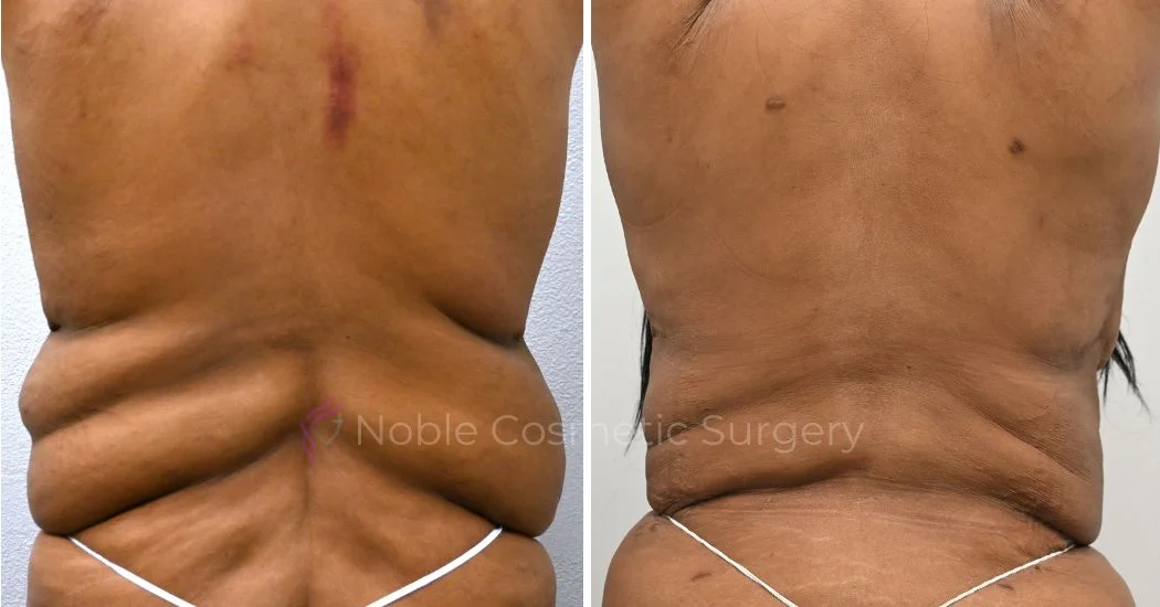 P5-00036A | Before and After Abdominoplasty 3