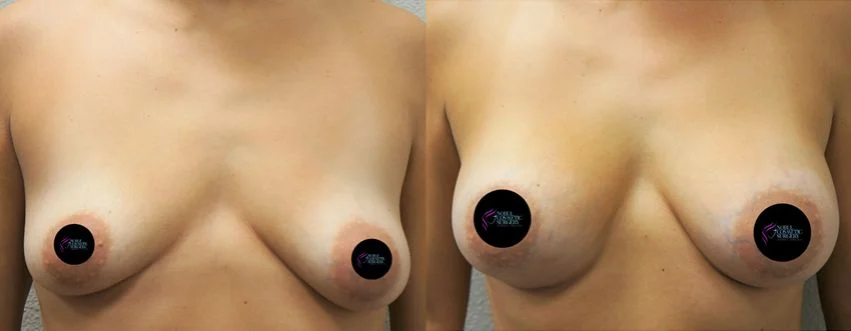 P5-16936 | Before and After Breast Augmentation 1