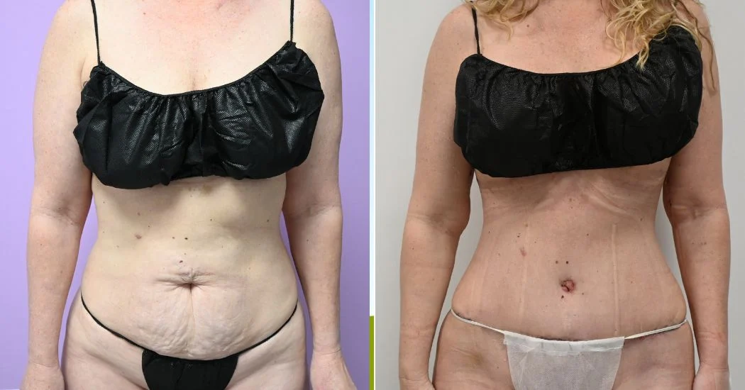 #20309 | Before and After Abdominoplasty 1