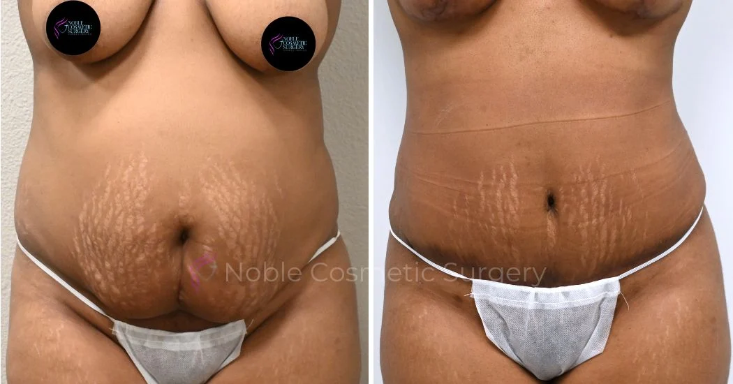 P6-00037A | Before and After Abdominoplasty 1